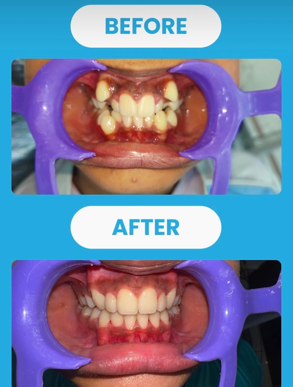 Orthodontic smile transformation