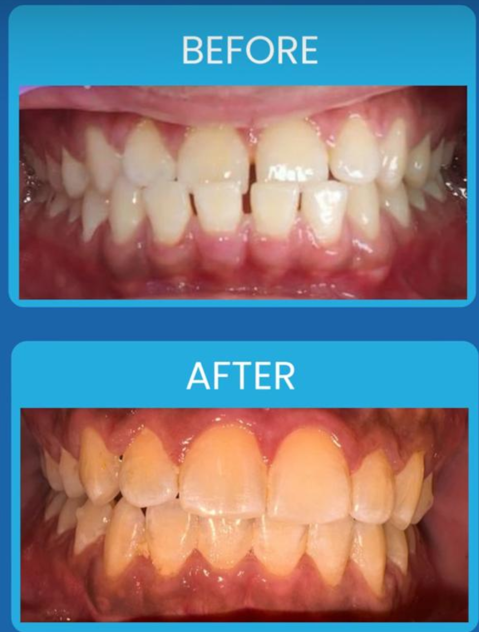 Teeth alignment treatment result
