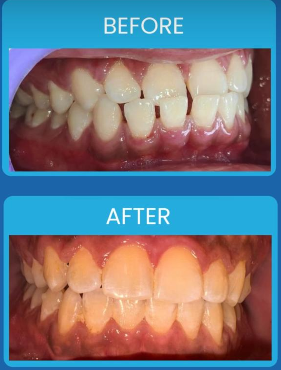 Dental treatment smile improvement