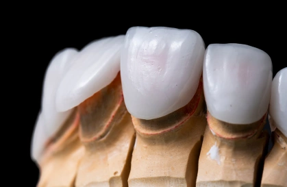 Ceramic dental solutions in Bellandur