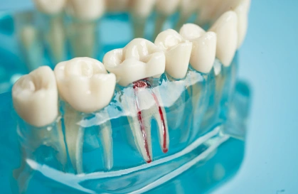 root canal 2